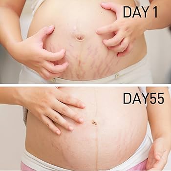 Bio Mama zwangerschapsolie - veilig en effectief tegen striae